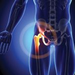 Orthopedics — Total hip replacement