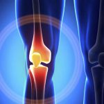 Orthopedics — Total knee replacement